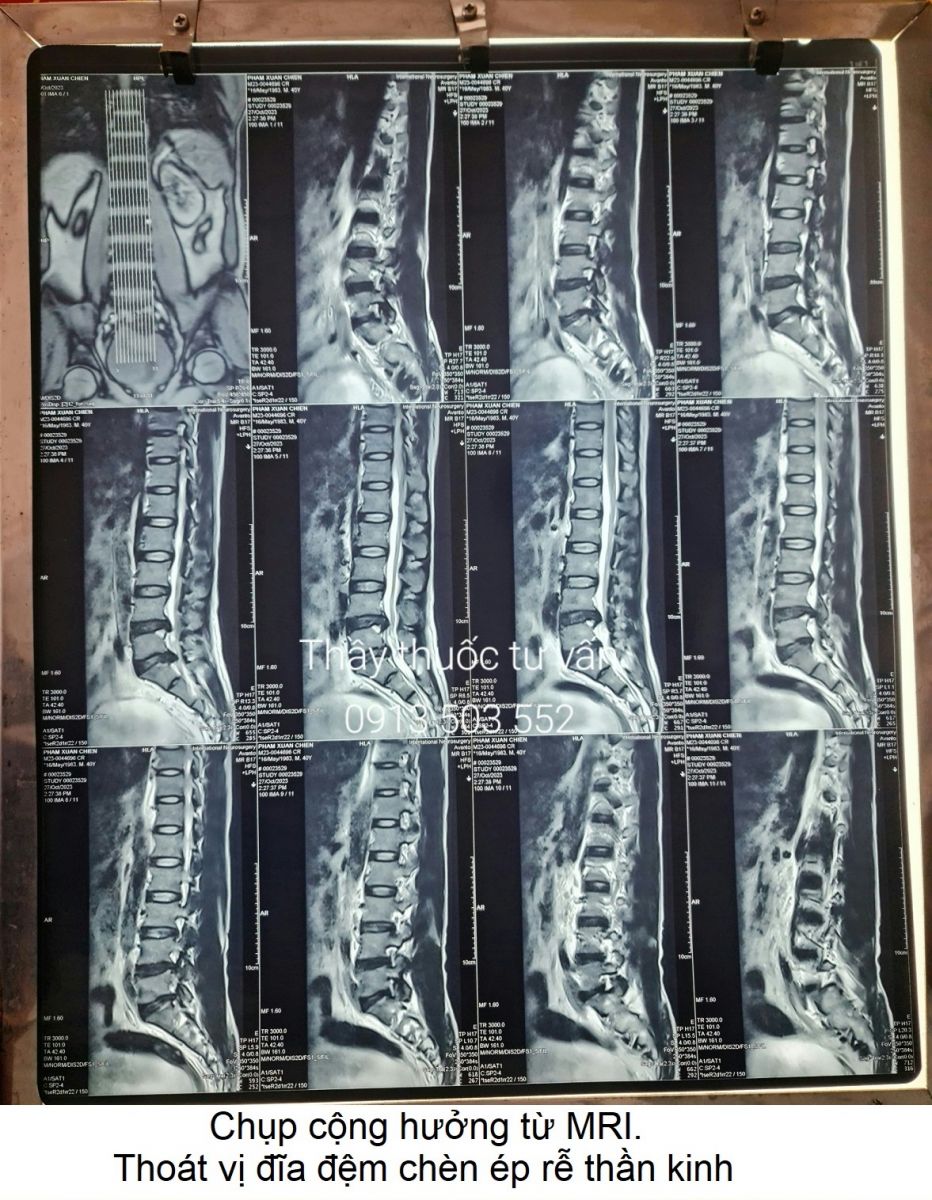 MRI thoát vị đĩa đệm 